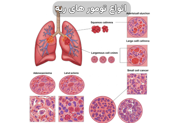 تومور های ریه 