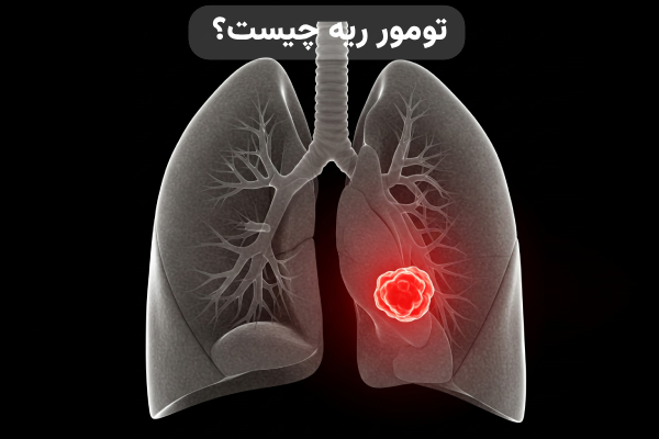 تومور های ریه