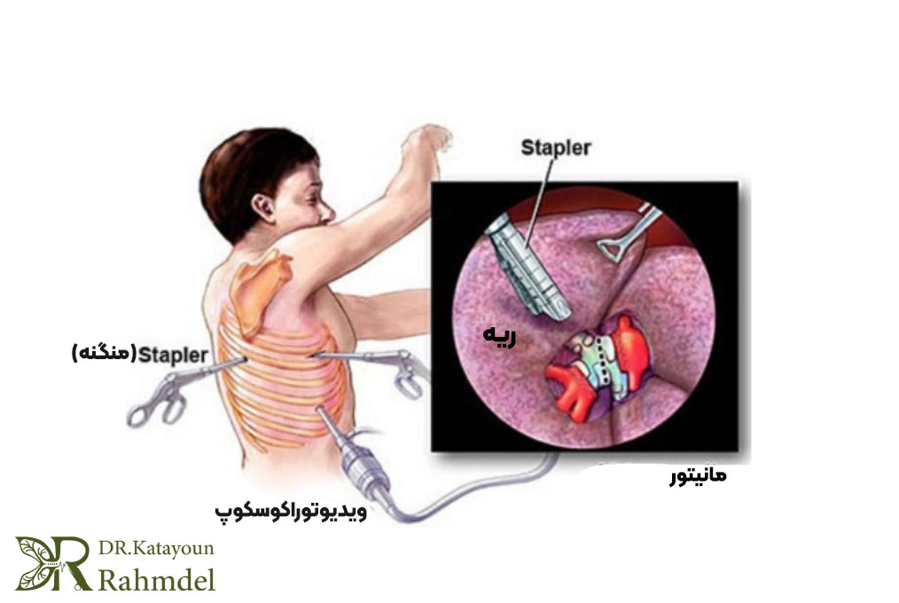 روش ‌های جراحی توراکس