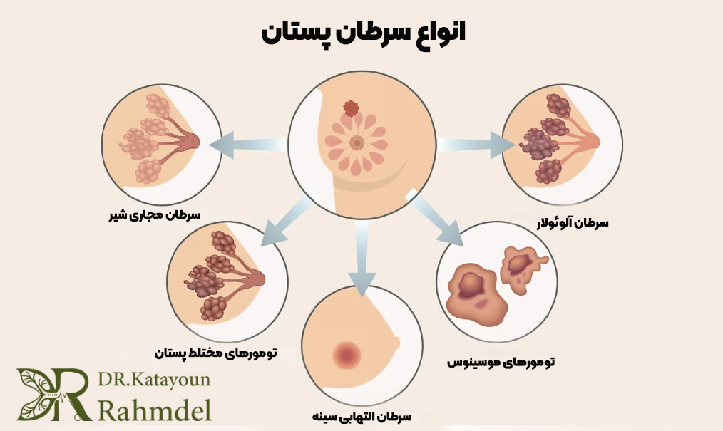 انواع سرطان سینه