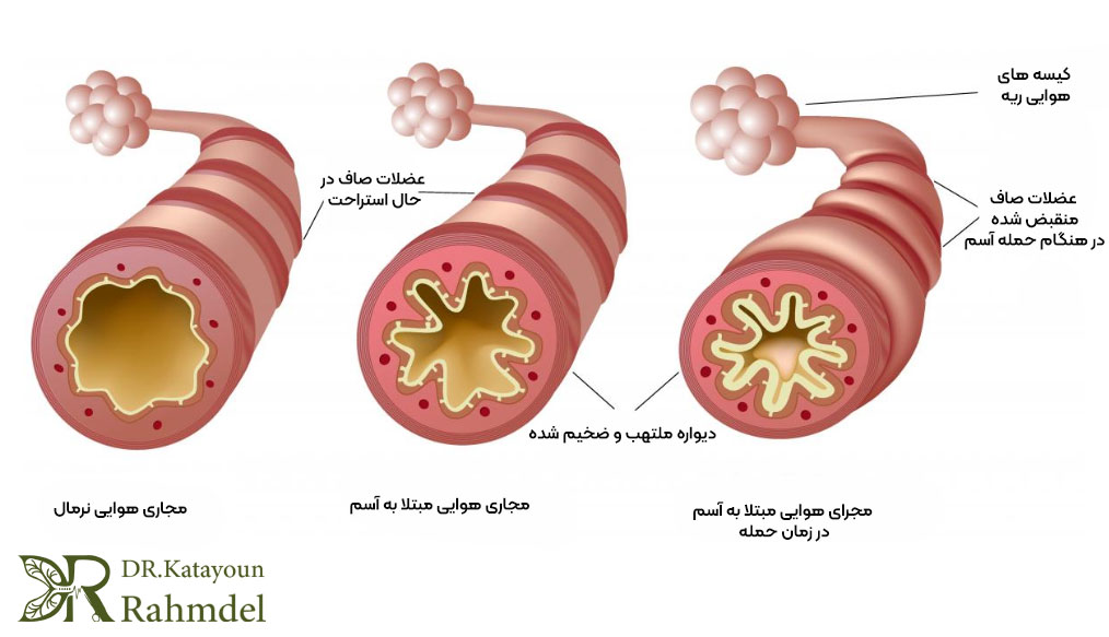 تفاوت آسم و تنگی نفس
