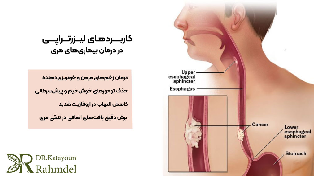 کاربردهای لیزرتراپی 