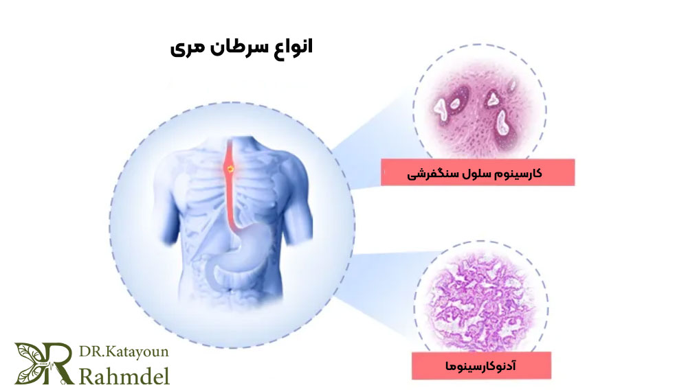  انواع سرطان مری