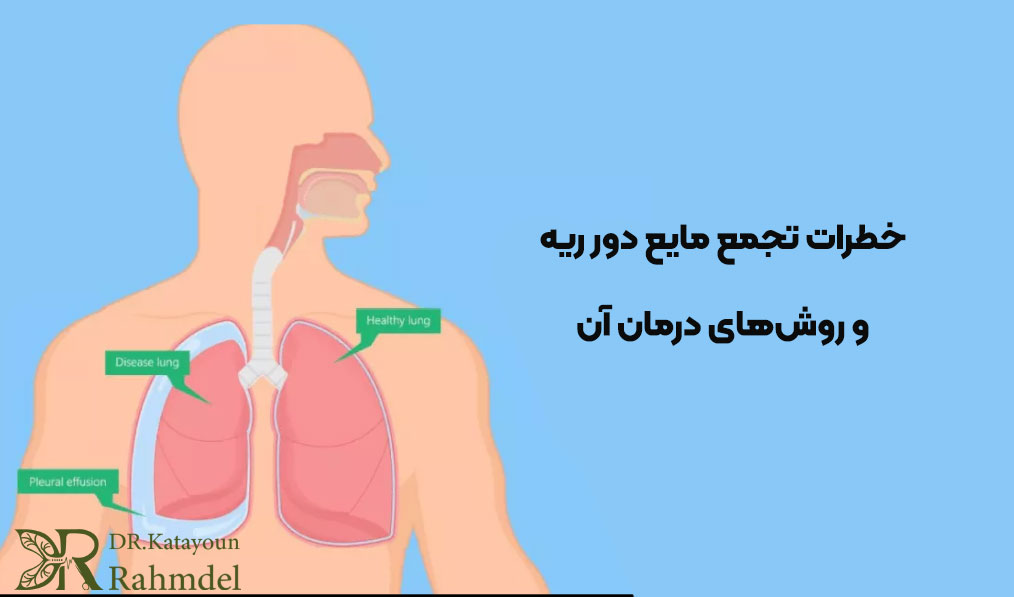 تجمع مایع دور ریه