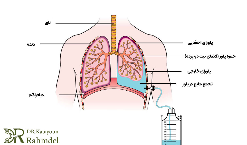 محل تجمع مایع دور ریه