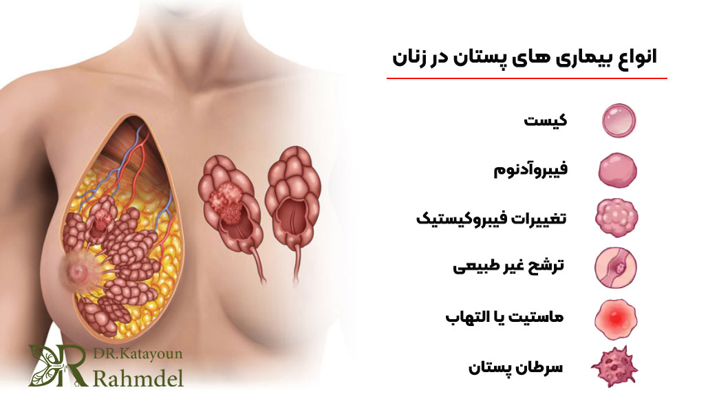 انواع بیماری های پستان در زنان