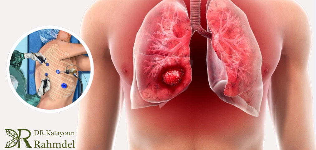درمان سرطان ریه 