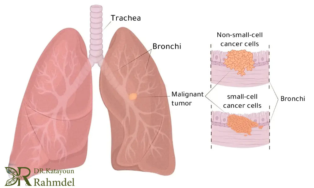 انواع سرطان ریه