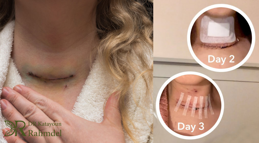 نحوه پانسمان و نگهداری از بخیه