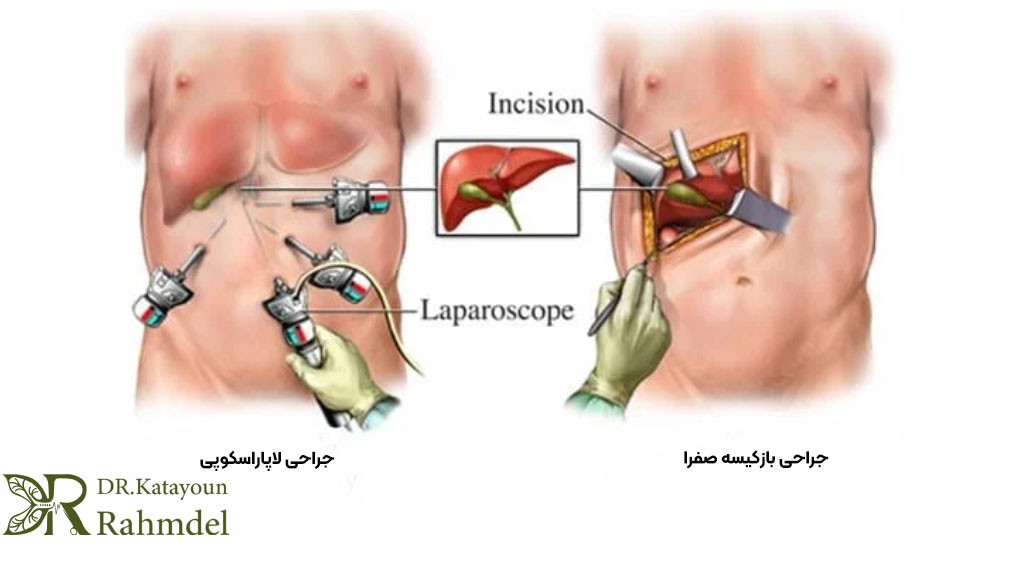 روش های جراحی کیسه صفرا