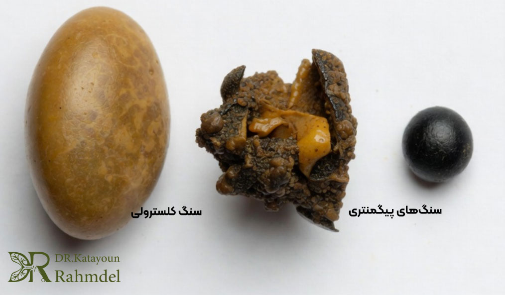 انواع سنگ کیسه صفرا
