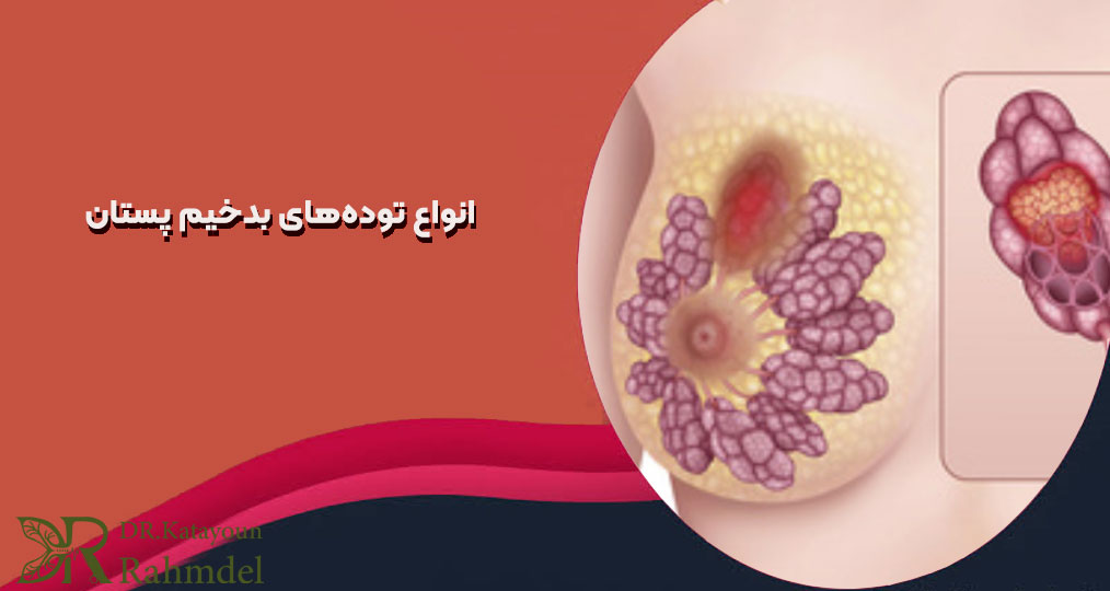 توده بدخیم پستان