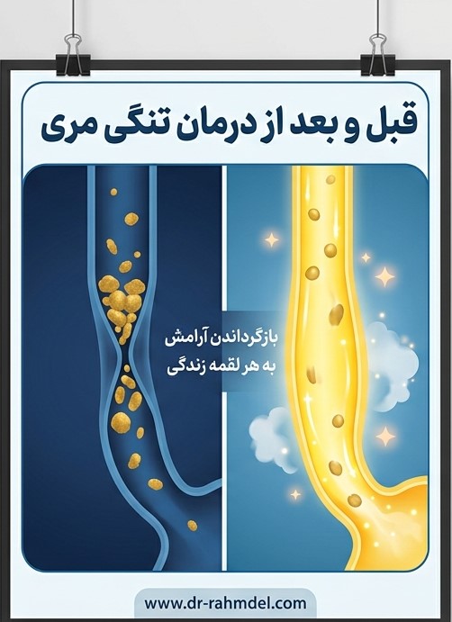 تنگی‌های خوش‌خیم مری